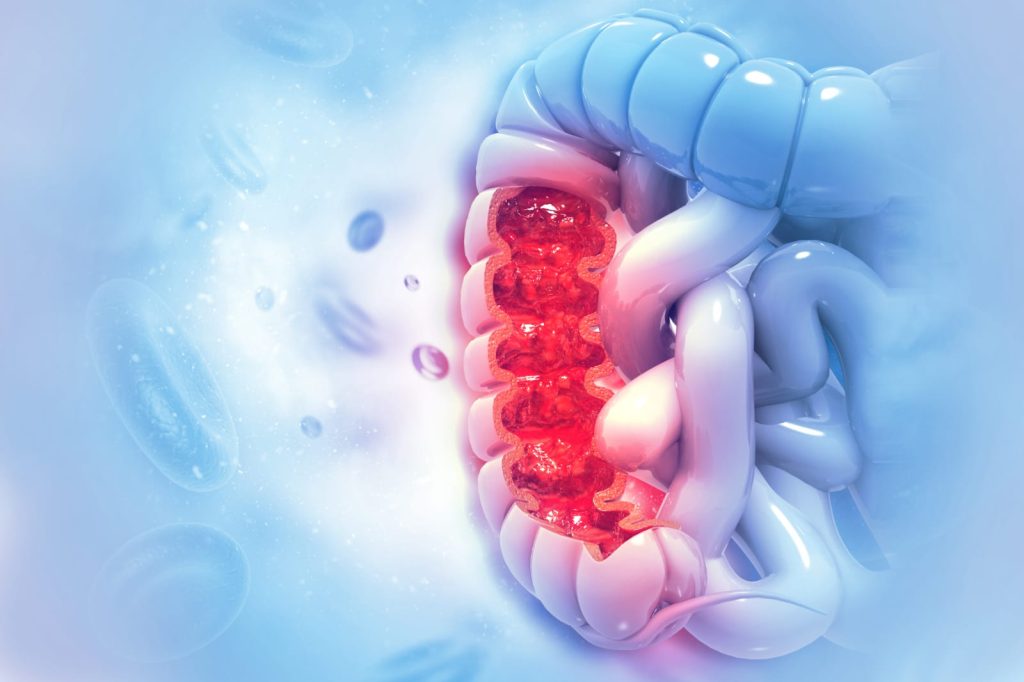 Cáncer de colon